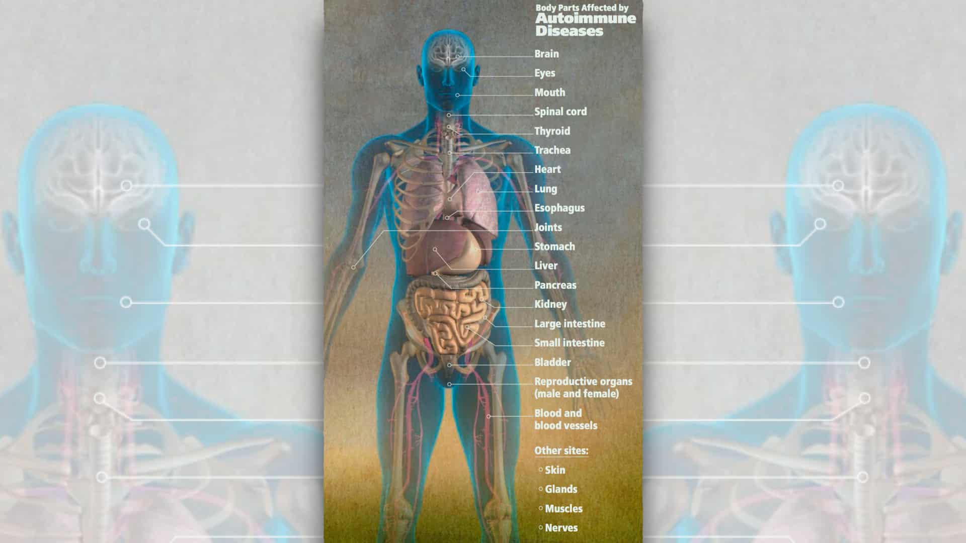 Fighting Lupus With Turmeric: Good as Gold